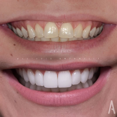 novo sorriso clareamento dental